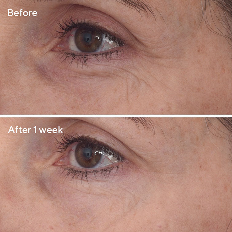 Retinal ReSculpt™ Eye Treatment