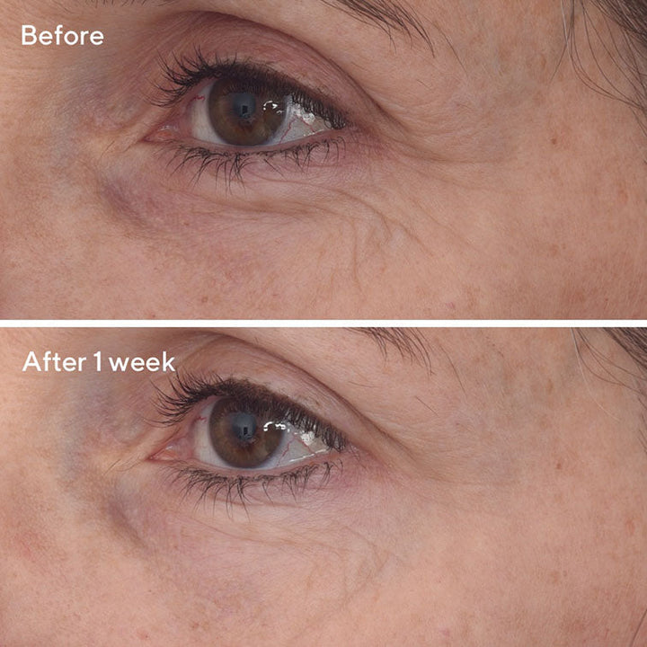 Retinal ReSculpt™ Eye Treatment